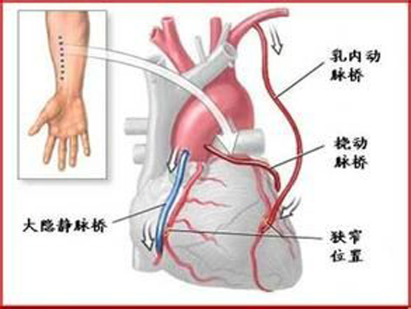 我院心脏外科冠脉搭桥手术再上新台阶